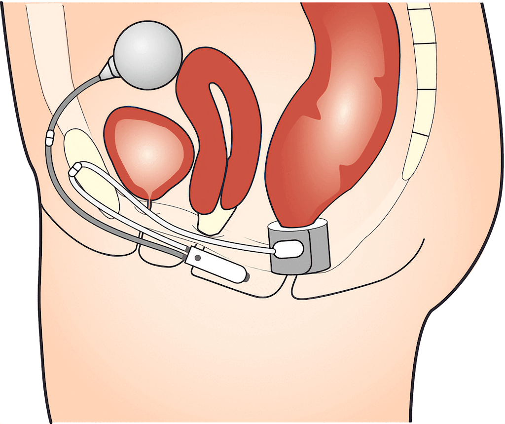Esfíncter artificial