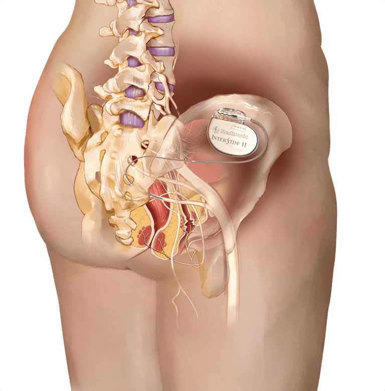 Neuromodulação sacral