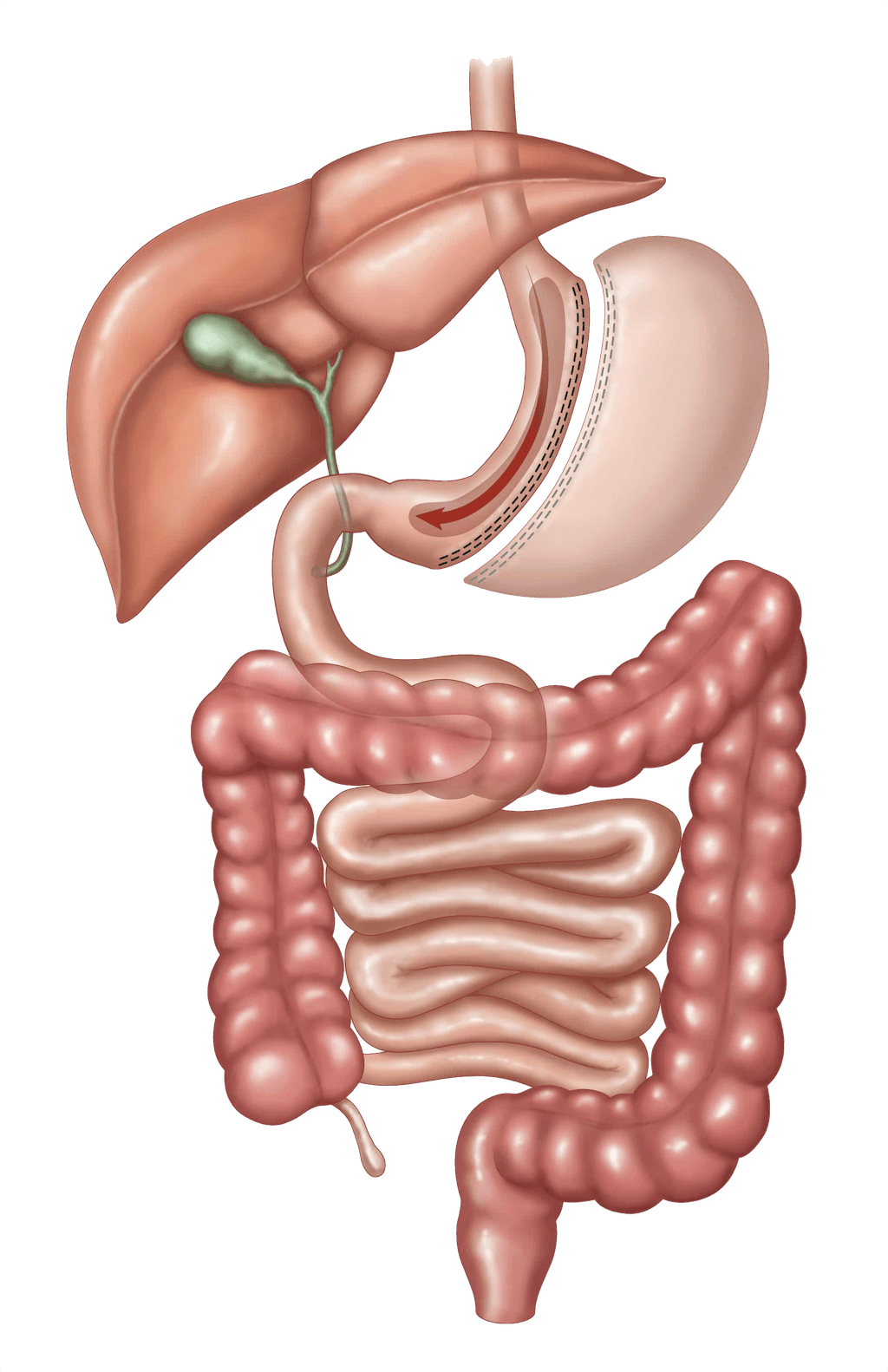 Cirurgia de gastrectomia vertical (Sleeve)